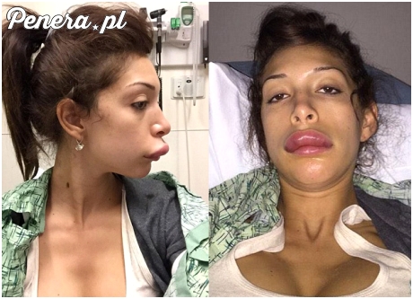 Bo chciała mieć piękne duże usta